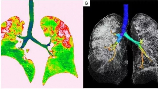 Virüsün akciğere etkisine dair bir görsel. Foto: Kuzey Amerika Radyoloji Derneği